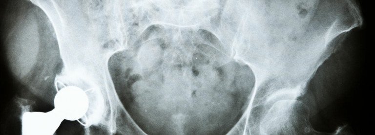 hip replacement